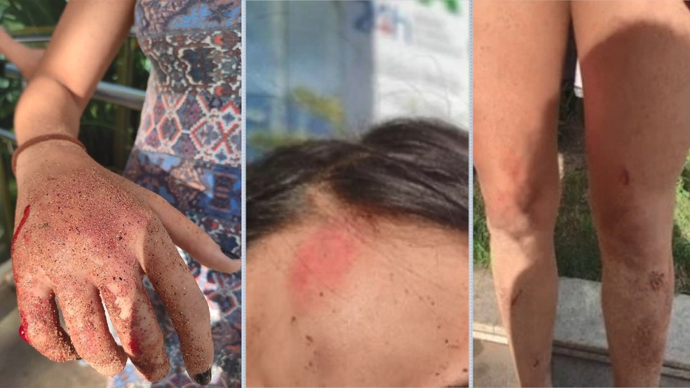 Jovem com barriga cortada: fotos mostram lesões nas mãos de namorada após noite em praia — Foto: Reprodução/TV Gazeta