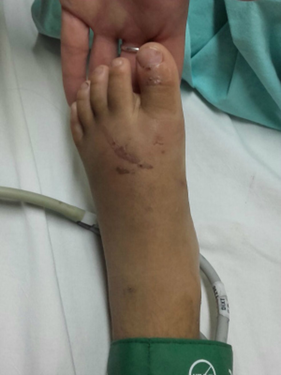 Criança tem ferimentos nos pés e teve uma das unhas arrancadas durante tortura em ritual (Foto: Divulgação/ Polícia Civil de MS/Arquivo)