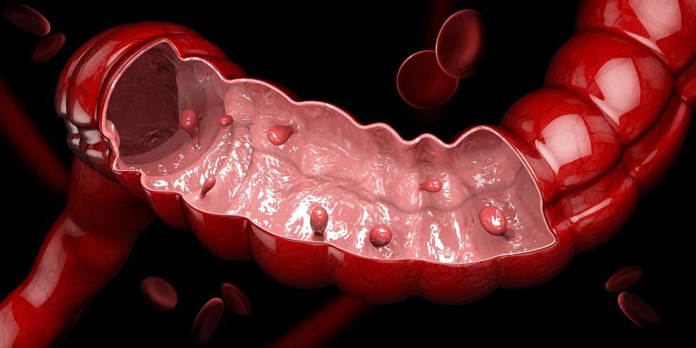 Pólipos no intestino: esse é o primeiro sinal de uma possibilidade de câncer futuro e deve ser investigado — Foto: Istock Getty Images