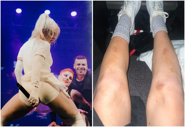 Luísa Sonza mostra hematomas na perna (Foto: Instagram/Reprodução)