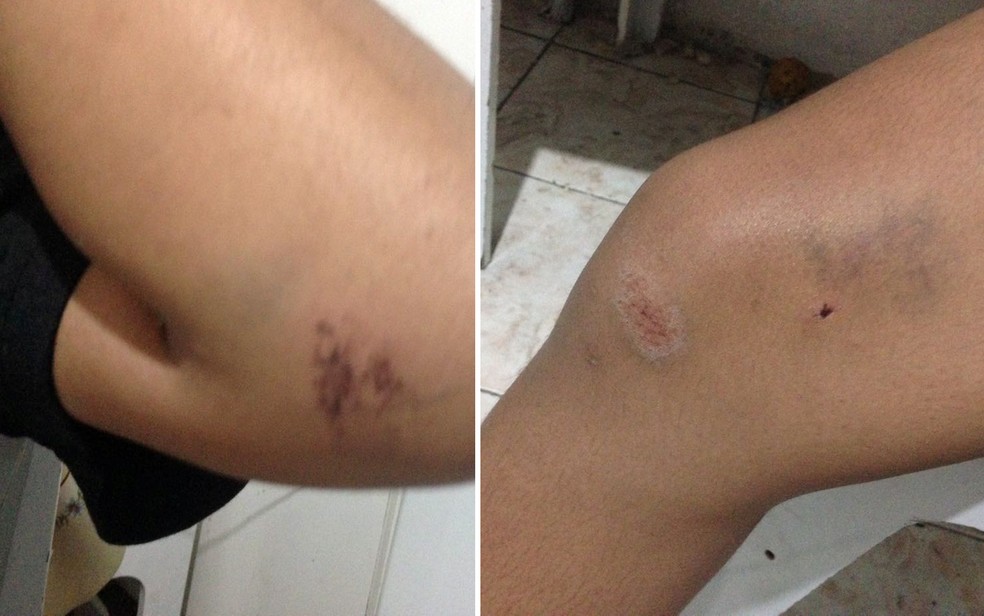 Jussara ficou com hematomas nas pernas e nos braços (Foto: Glauco Araújo/G1)