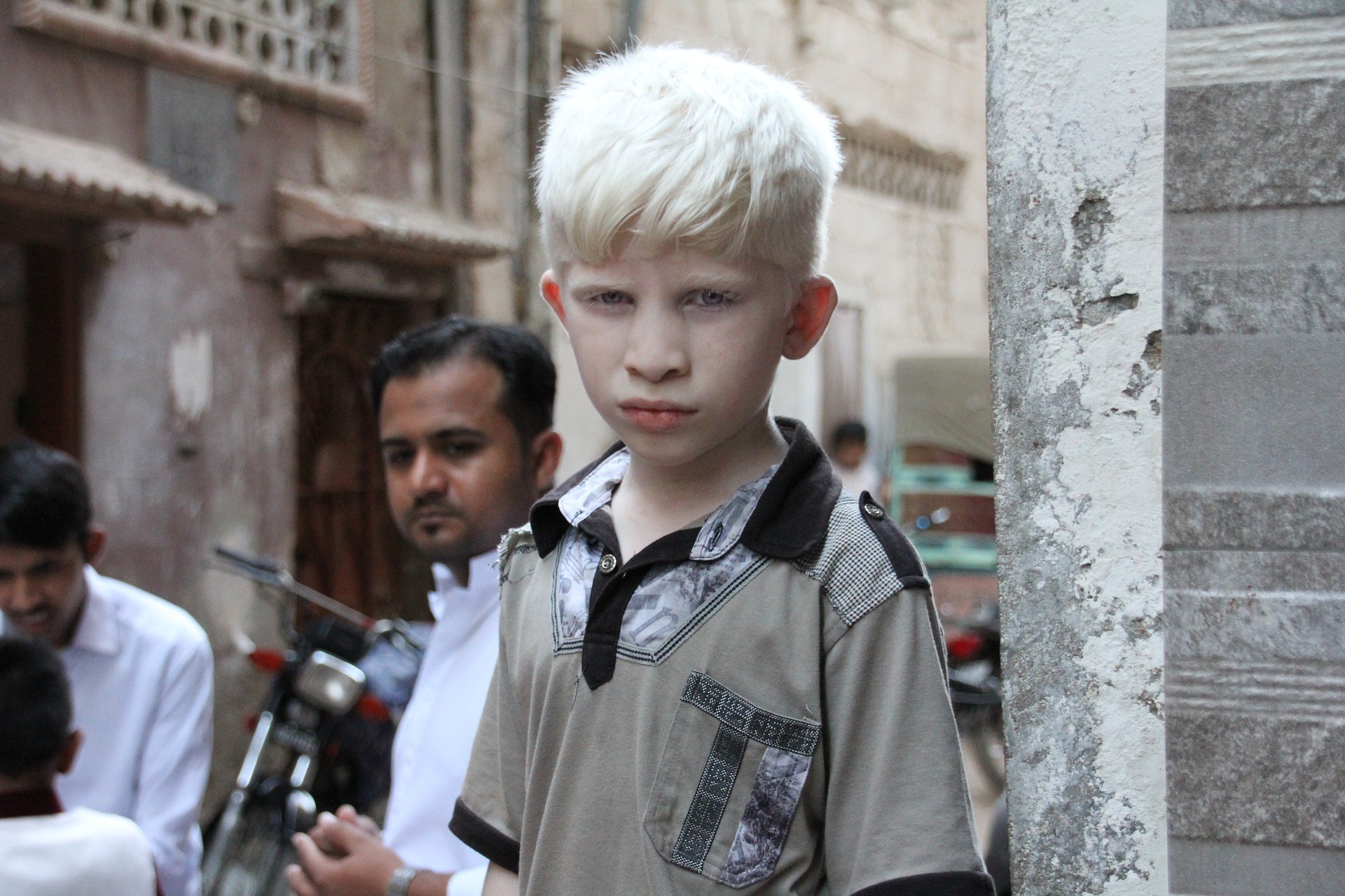 Menino que apresenta albinismo, condição que afeta milhares de pessoas ao redor do planeta (Foto: Pixabay)
