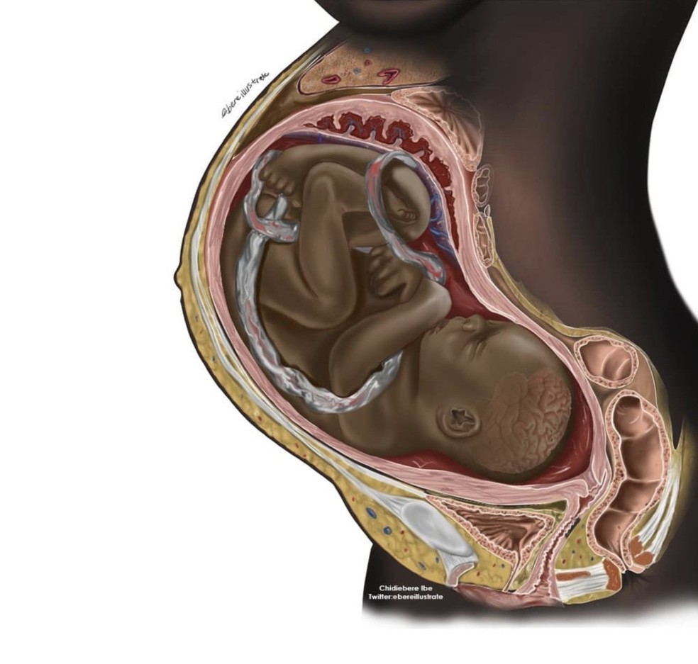 Ilustração médica do nigeriano Chidiebere Ibe mostra feto de pele negra dentro da mãe, também negra. — Foto: Reprodução/Chidiebere Ibe