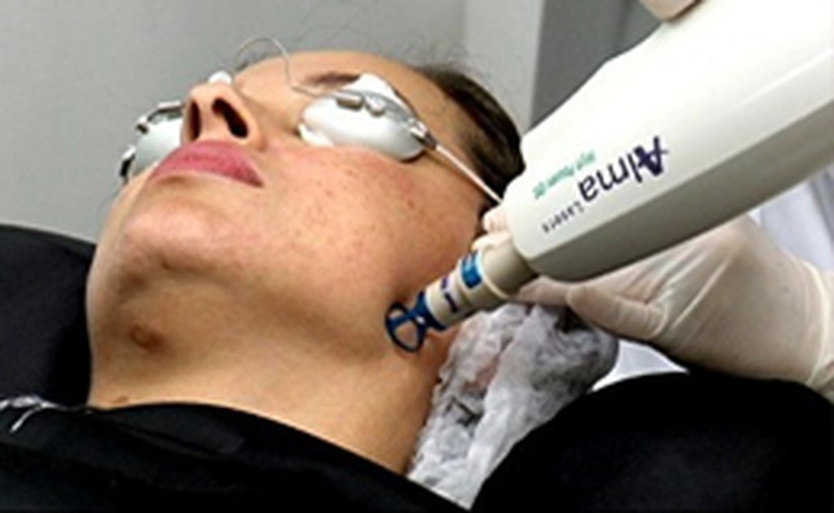 Como clarear manchas de pele: conheça tratamento a laser | Moda e
