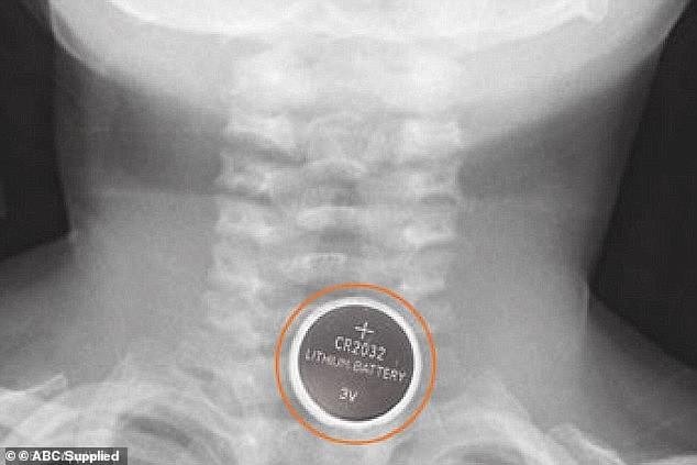 criança engole bateria botão (Foto: Reprodução Instagram)