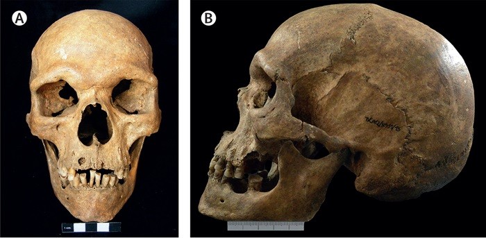 Vistas anterior (A) e lateral (B) do crânio com provável má oclusão e prognatismo maxilar revelado por desgaste dentário atípico (Foto: The Lancet/Xavier Roca-Rada, MSc et.al )