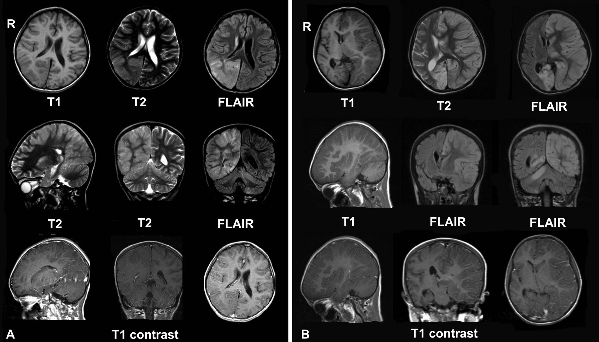 A ressonância magnética poderia indicar a atividade cerebral de pacientes considerados vegetativos (Foto: Wikimedia Commons)