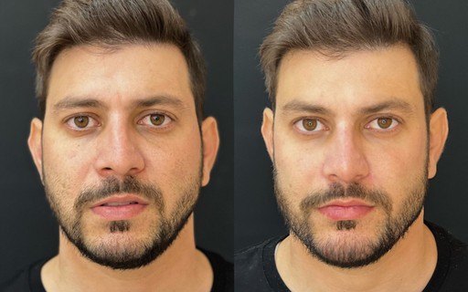 Caio Afiune faz harmonização facial; veja o antes e depois