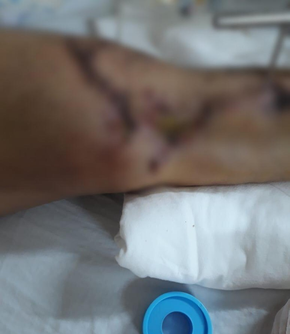 Jovem de MS mostra lesões na perna após acidente — Foto: Pamella Damião/Arquivo Pessoal