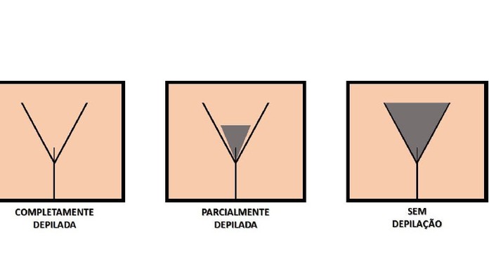 Homens E Mulheres Preferem Depilacao Completa Da Regiao Genital Feminina Diz Usp Ribeirao Preto E Franca G1 Como funciona depilação a laser na virilha? homens e mulheres preferem depilacao