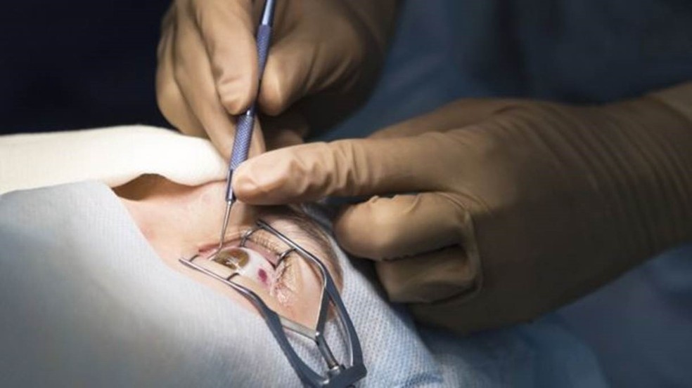 O descobrimento da camada de dua ajuda a tornar as cirurgias oculares mais simples — Foto: Getty Images/BBC