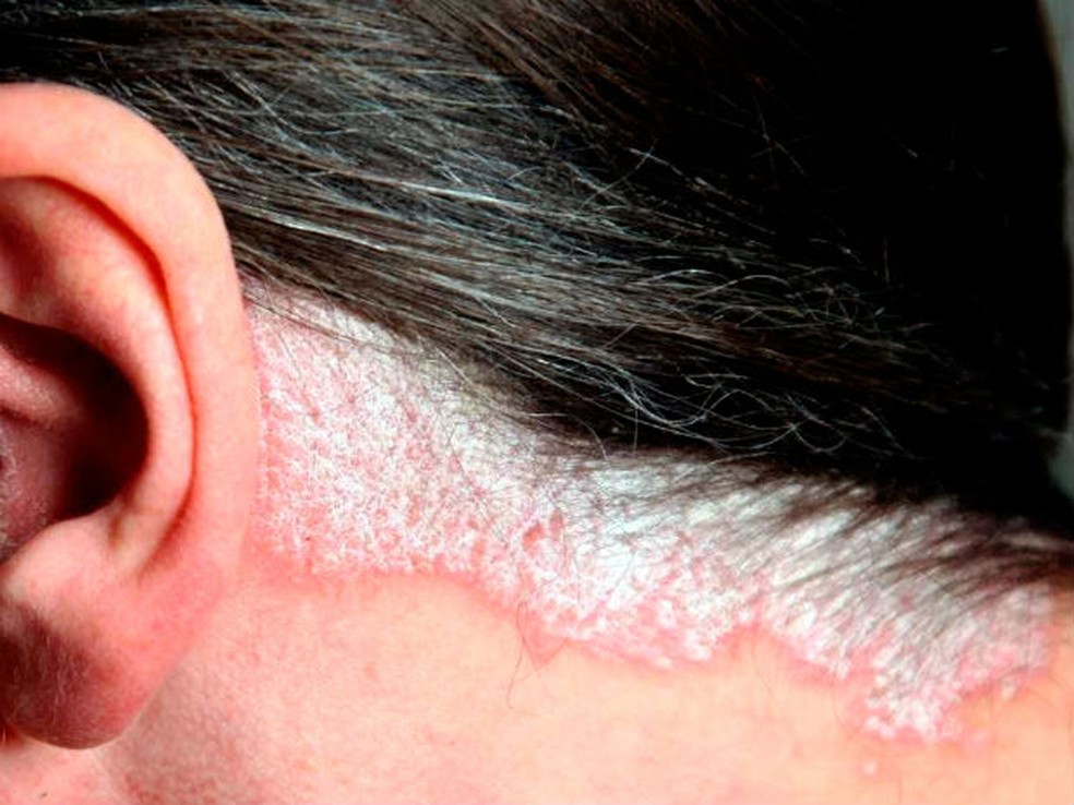 Psoríase causa escamas espessas e secas no couro cabelo — Foto: Divulgação