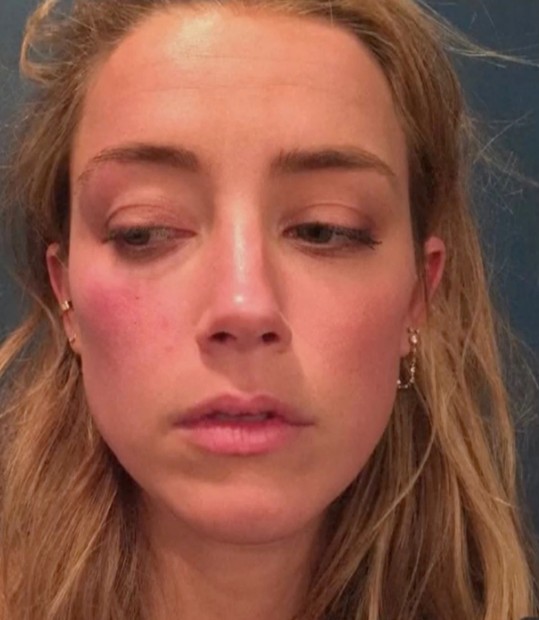 Amber Heard exibe à corte fotos da suposta agressão que sofreu de Johnny Depp (Foto: Reprodução YouTube)