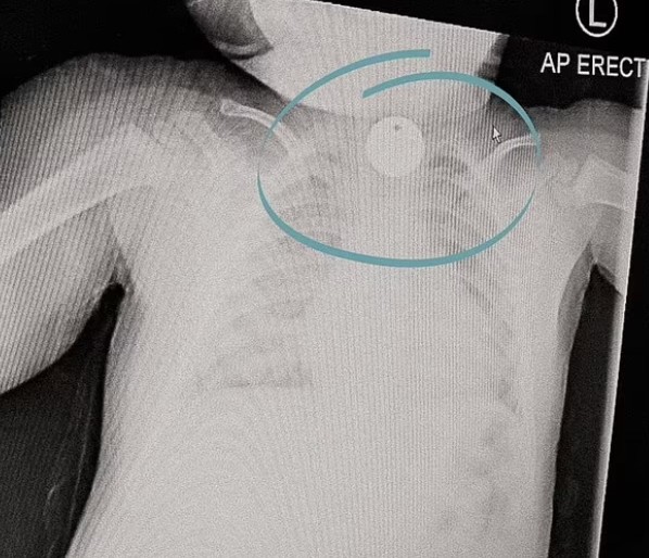 Risco de asfixia: objeto ficou entalado na garganta da criança (Foto: Reprodução/Daily Mail)