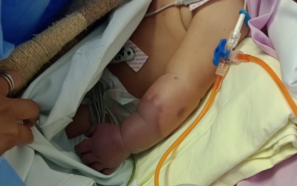 Mãe mostra foto de bebê com o braço roxo dentro de UTI, em Goiânia — Foto: Reprodução/TV Anhanguera
