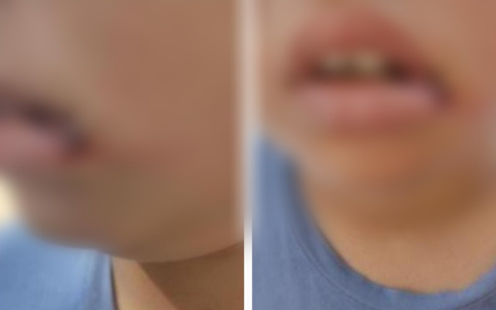 Criança teve dois dentes quebrados e a boca cortada — Foto: Reprodução/Polícia Militar 