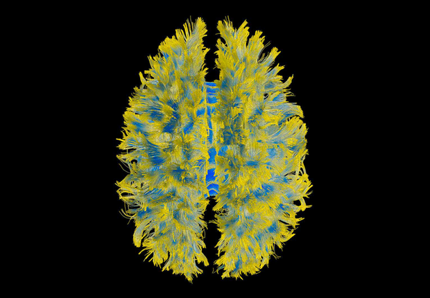 Tomografia cérebro (Foto: GE)