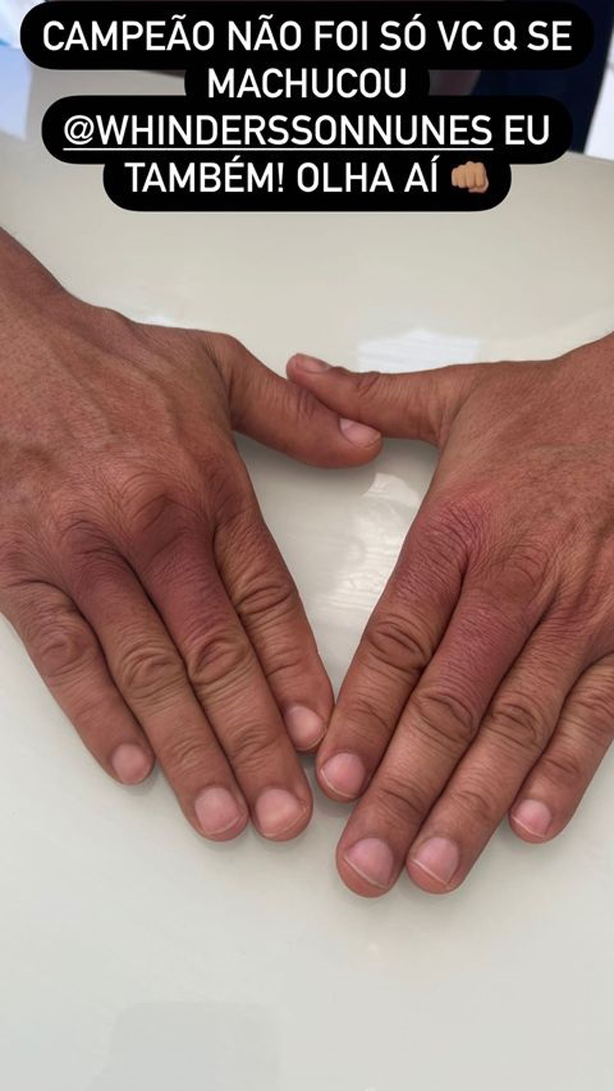 As mãos de Popó após a luta com Whindersson Nunes (Foto: Reprodução Instagram)