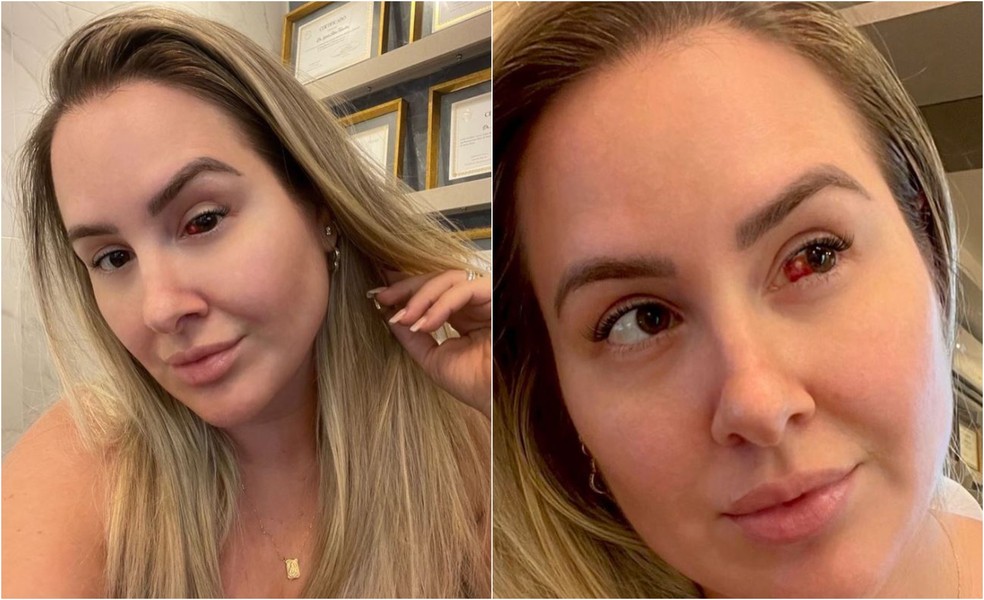 Ex-BBB cearense Patrícia Leite foi diagnosticada com derrame ocular. — Foto: Instagram/ Reprodução