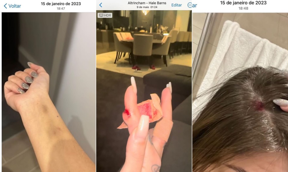 Gabi Cavallin mostrou marcas de agressão — Foto: Reprodução/Segue A Cami