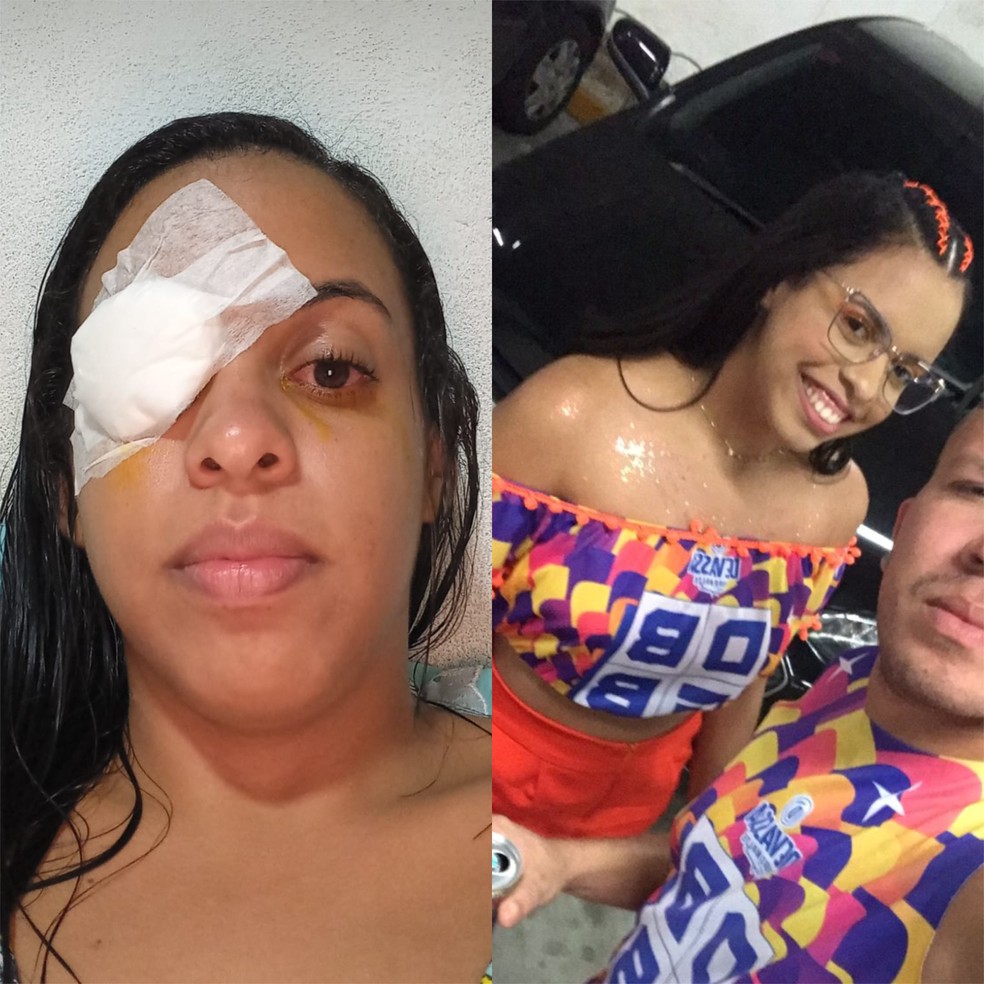 A dona de casa Mayara Santana está usando tampão no olho após sofrer queimadura na retina após pomada capilar cair nos olhos — Foto: Mayara Santana/Arquivo pessoal