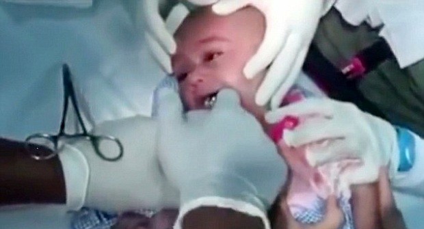 Médico retira relógio da garganta de bebê na Arábia Saudita (Foto: Reprodução Youtube)