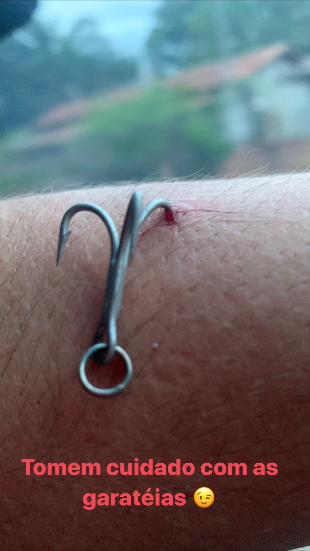 Fernando prendeu um anzol em seu braço em acidente de pesca (Foto: Reprodução/Instagram)