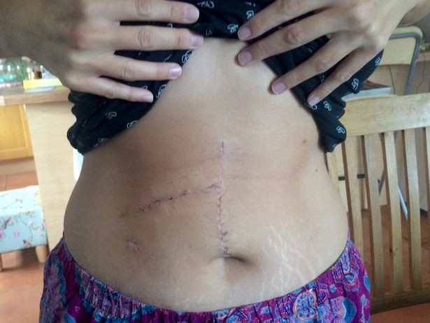 Jemma, 32, ficou com enorme cicatriz após a cirurgia (Foto: Caters News)