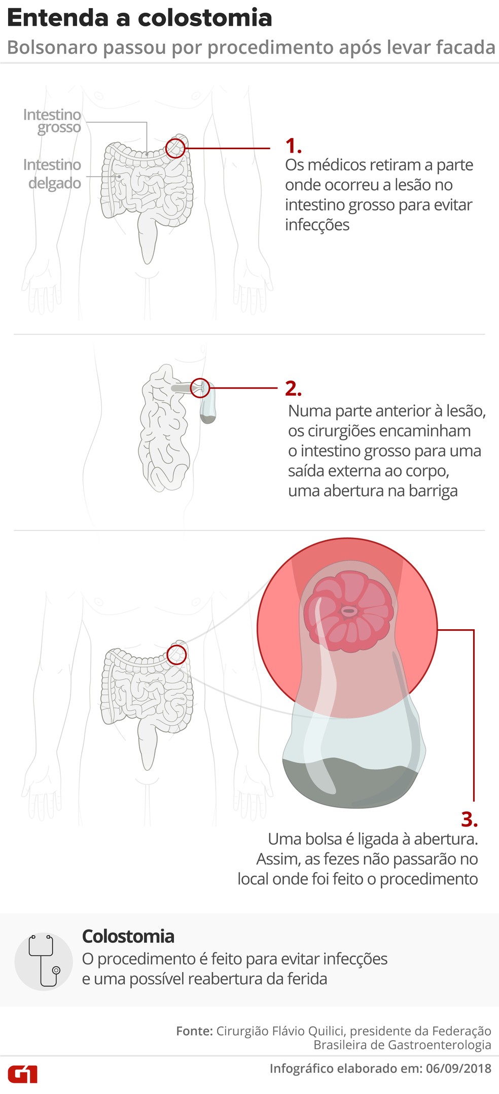 Colostomia: entenda o procedimento que passou Bolsonaro (Foto: Igor Estrella e Alexandre Mauro/G1)