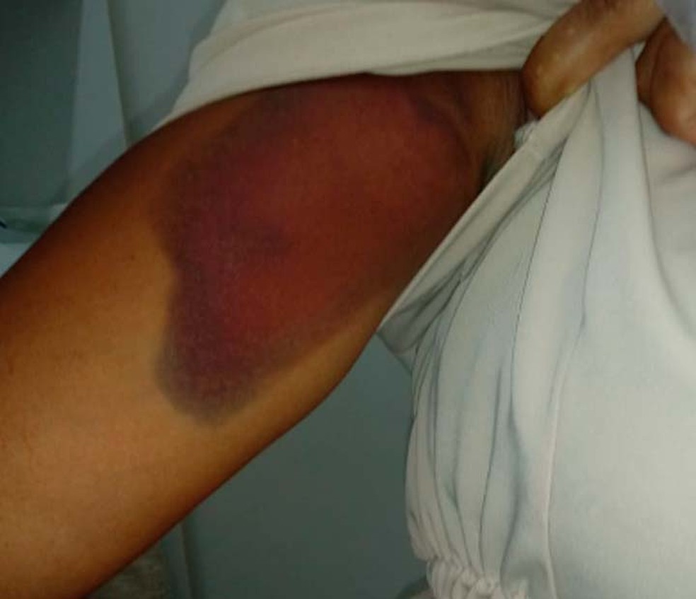 Hematoma no braÃ§o da mulher que foi agredida por assaltante no Bonfim, em Salvador â€” Foto: Arquivo Pessoal