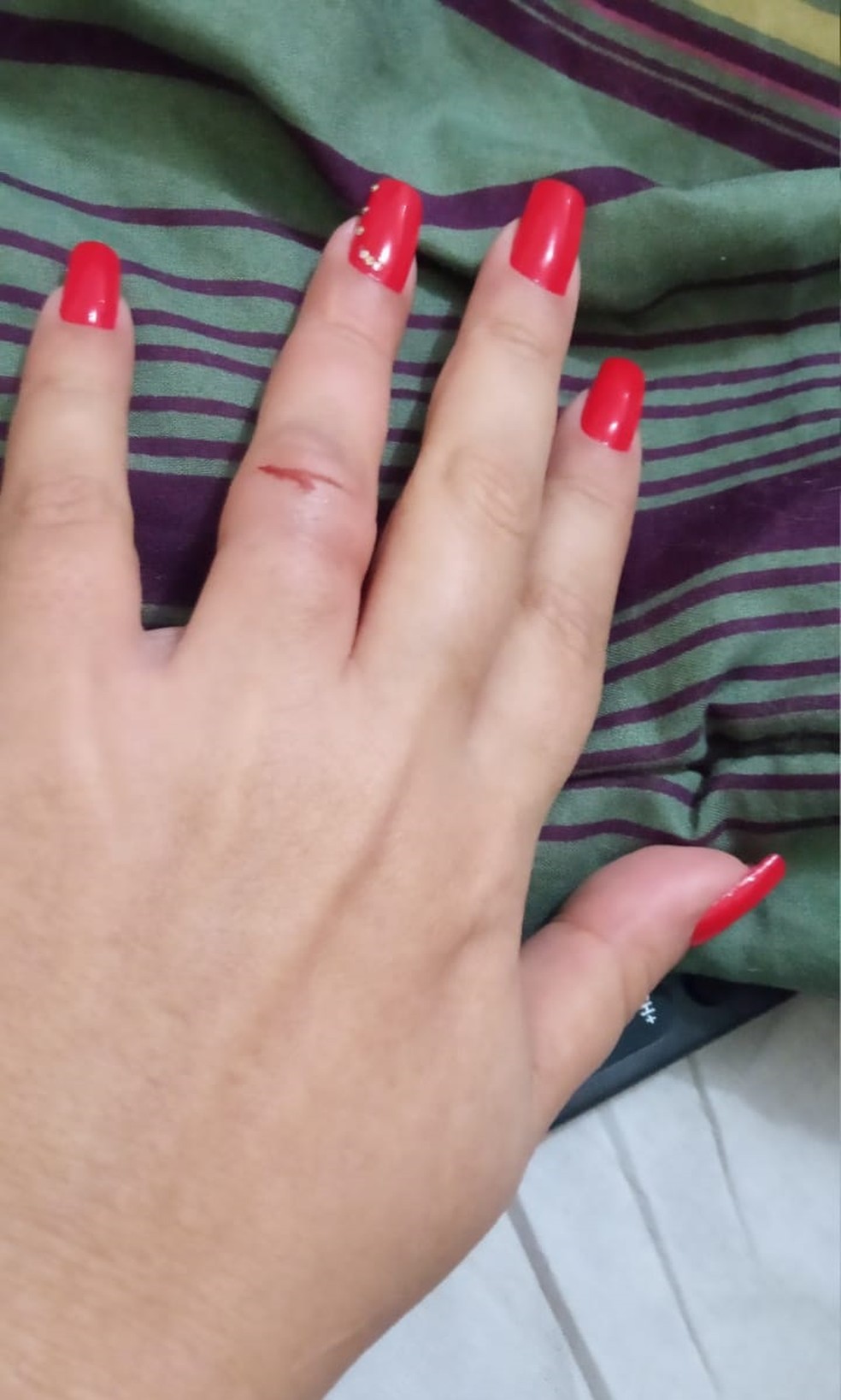 Dedo de mulher ficou machucado e inchado após assalto. — Foto: Arquivo pessoal