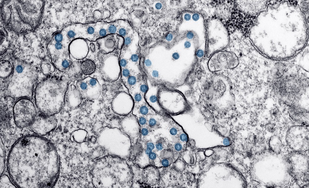 Microscópio mostra amostra de primeiro caso do coronavírus Sars-Cov-2 nos EUA, isolado em laboratório.  — Foto:  Hannah A Bullock; Azaibi Tamin/CDC