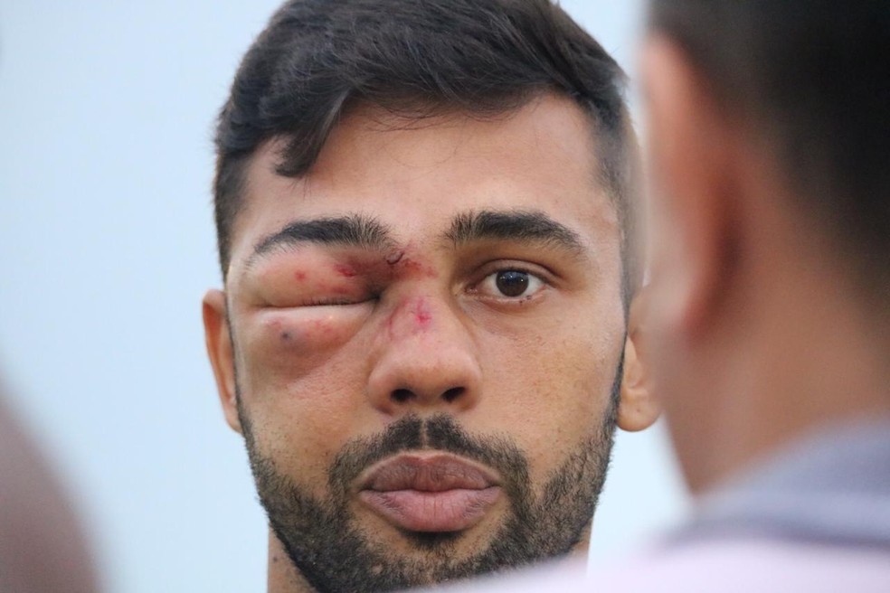 ApÃ³s chute no rosto, Humberto relata ter "apagado" em campo â€” Foto: Stephanie Pacheco/GloboEsporte.com