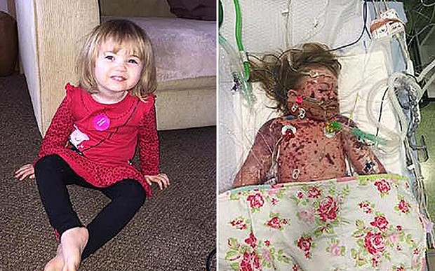 Faye Burdett, de 2 anos, antes e depois da meningite (Foto: Reprodução)