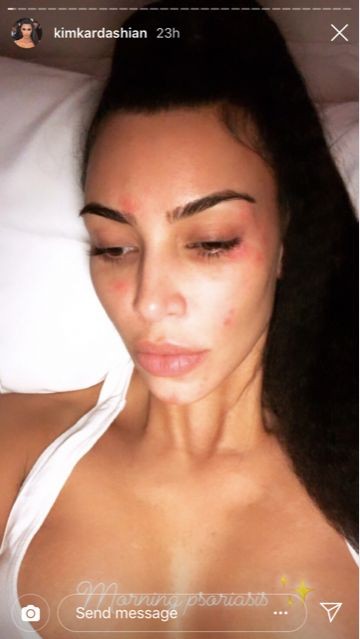 KIm Kardashian mostra efeitos de doença autoimune (Foto: Reprodução/Instagram)
