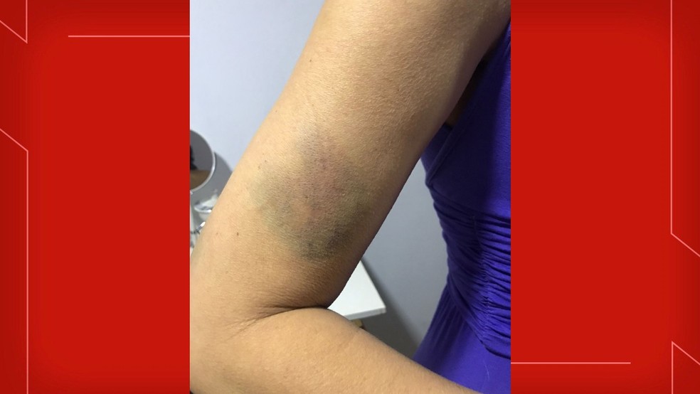 Braço de mulher fica roxo após ser agredida por ex-companheiro, professor da UnB, em Brasília — Foto: Arquivo pessoal