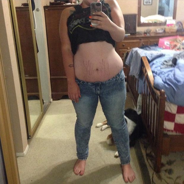 A usuária do Instagram Carly Sunflower que postou imagem de sua barriga com estrias: 