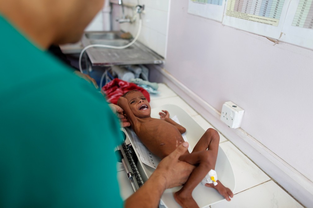 CrianÃ§a sub-nutrida Ã© atendida em hospital no IÃªmen. â Foto: REUTERS/Khaled Abdullah