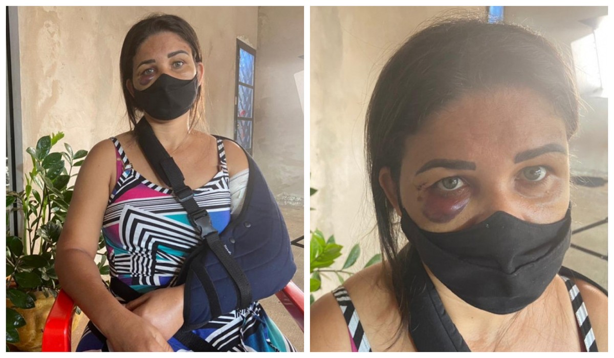 Funcionária de padaria tem braço quebrado por cliente após pedir para homem usar máscara contra a Covid