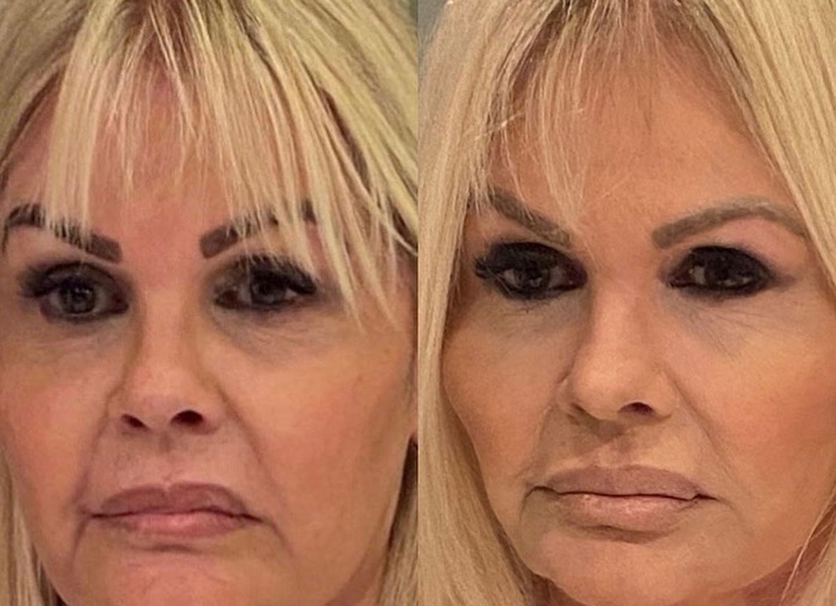 Monique Evans posta antes e depois de procedimento na face (Foto: Reprodução/Instagram)