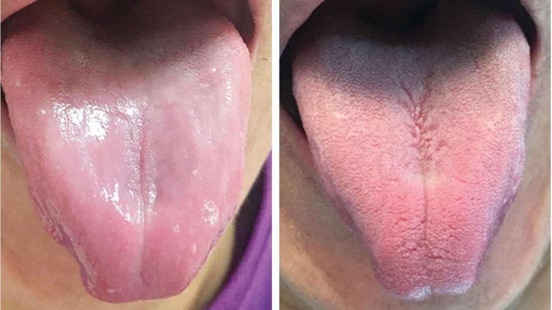 Médicos registraram a língua do paciente antes (à esquerda) e depois (à direita) do tratamento (Foto: Divulgação)