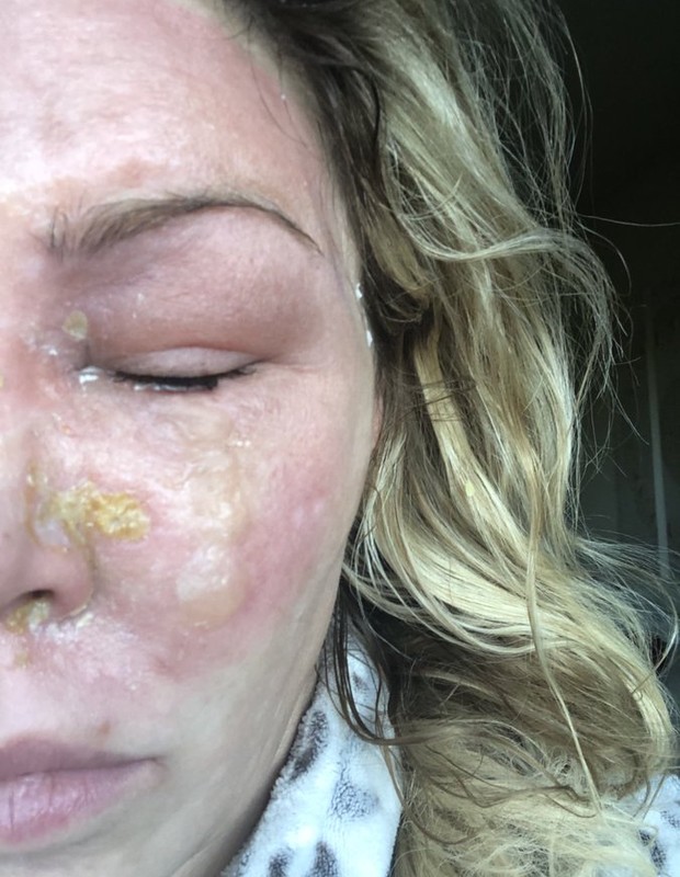 Brandi Glanville sofre queimadura ao tratar psoríase (Foto: Reprodução/Twitter)