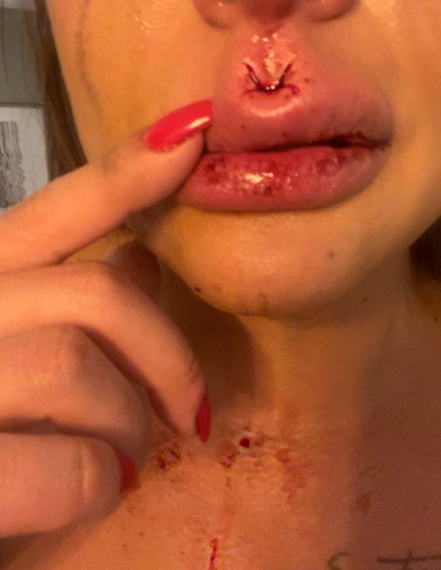 Silvye Alves sofreu lesões no rosto e precisou ser submetida a procedimentos cirúrgicos após agressão do ex (Foto: Reprodução/Instagram)