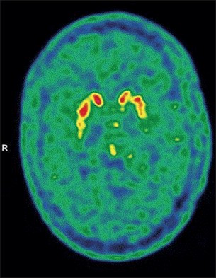 A neuroimagem mostrou ingestão reduzida de 18F-FDOPA, um aminoácido analisado no diagnóstico da doença de Parkinson, em ambos os putâmens (uma estrutura localizada na base do lobo frontal do cérebro) mais obviamente no lado esquerdo.  (Foto: Caso de provável doença de Parkinson após infecção por SARS-CoV-2)