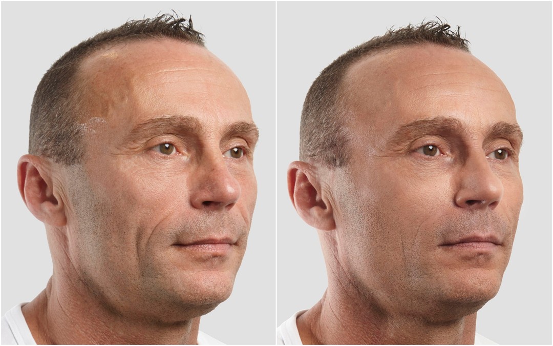 O antes e o depois de um homem que passou pelo processo de colocar fios de sustentação da Silhouette Soft (de ácido polilático).  (Foto: Divulgação)