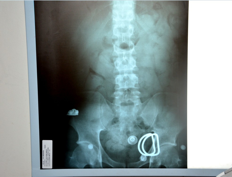 Radiografia mostrou a droga no est&ocirc;mago do venezuelano (Foto: Ascom/PF)