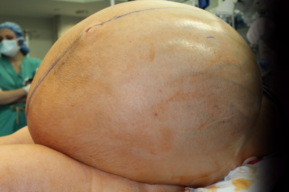 Tumor de quase 60kg no ovÃ¡rio de mulher nos Estados Unidos  (Foto: DivulgaÃ§Ã£o)