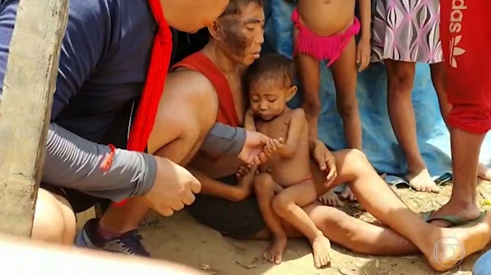 Criança Yanomami em estado grave. Foto: Alexandro Pereira/Rede Amazônica