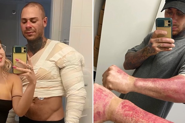 Leo Stronda mostra ferimentos após explosão de botijão de gás (Foto: Reprodução/Instagram)