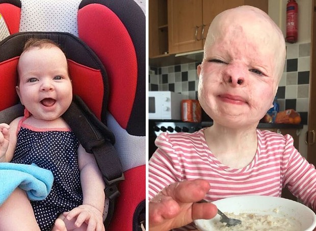 À esquerda, Elizabeth com 6 meses, pouco antes do acidente e, à direita, com 7 anos (Foto: Reprodução/Mirror)